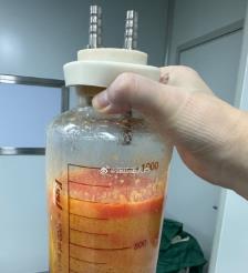 慈利水动力吸脂手术要做多久？